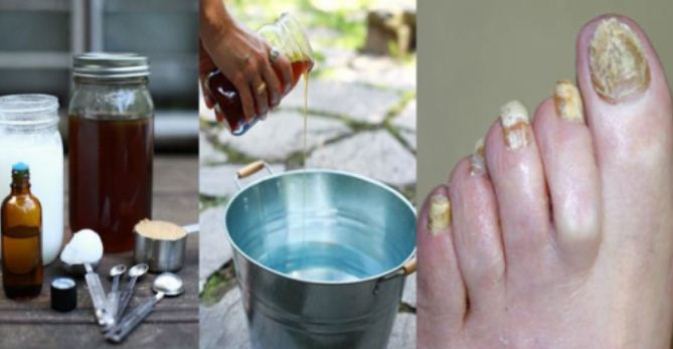 This-Super-Easy-2-Ingredient-Way-Will-Get-Rid-of-Nail-Fungus-Forever